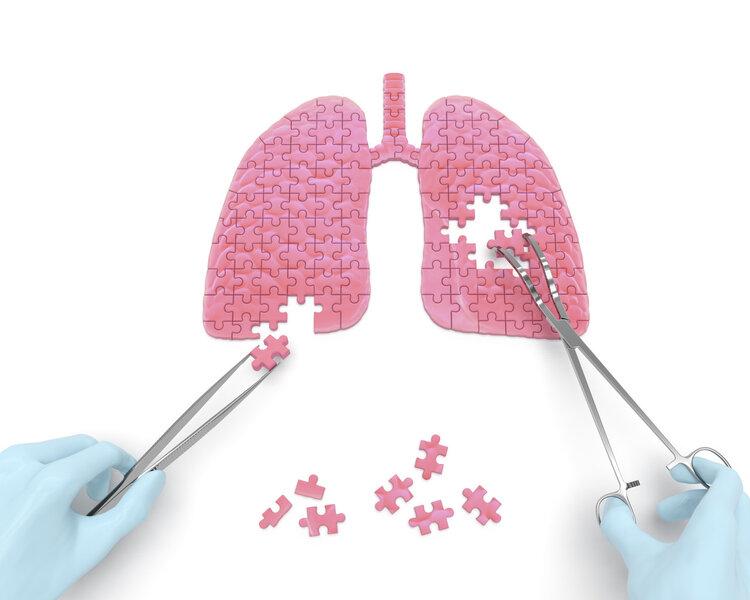 肺癌晚期有治好的案例嗎