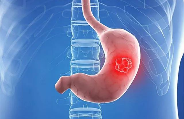 胃癌的早期癥狀和治療胃癌的靶向藥推薦